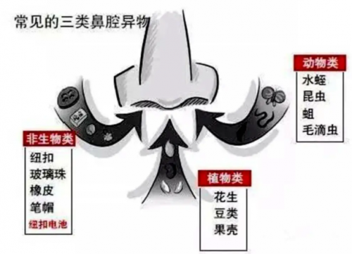 清鼻堂：孩子无故鼻疼、流鼻血，警惕鼻腔异物 ！